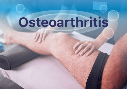 Osteoarthritis Treatment